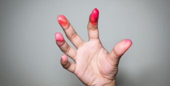 how to get rid of hot cheeto stains on fingers