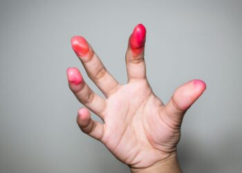 how to get rid of hot cheeto stains on fingers